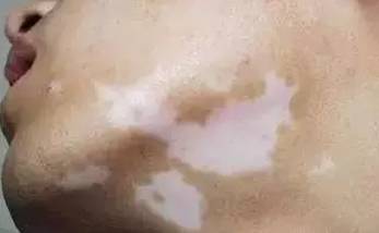 哪些因素导致了颈部白癜风的发病